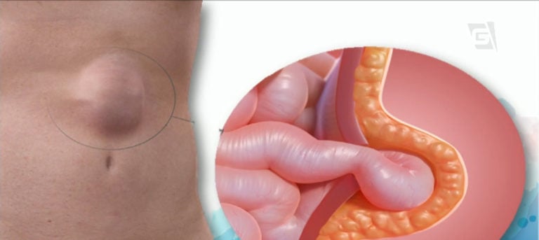 Imagem de capa representando o destaque: Hérnia Abdominal: saiba sinais e como cuidar da doença