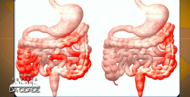 Imagem de capa representando o destaque: Diverticulite : O que é, quais os sintomas e quando procurar um médico?