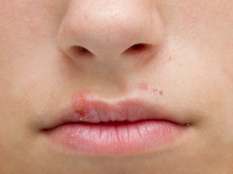 Herpes: sintomas, transmissão e como tratar