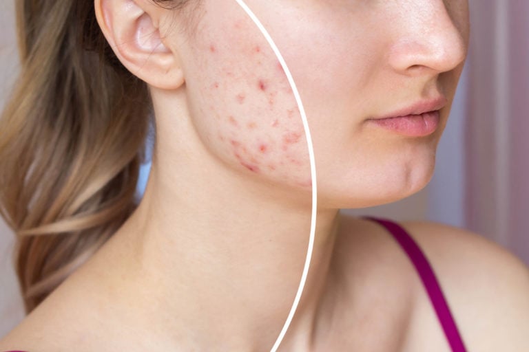 Imagem de capa representando o destaque: Estresse e pele: quais os impactos e como cuidar