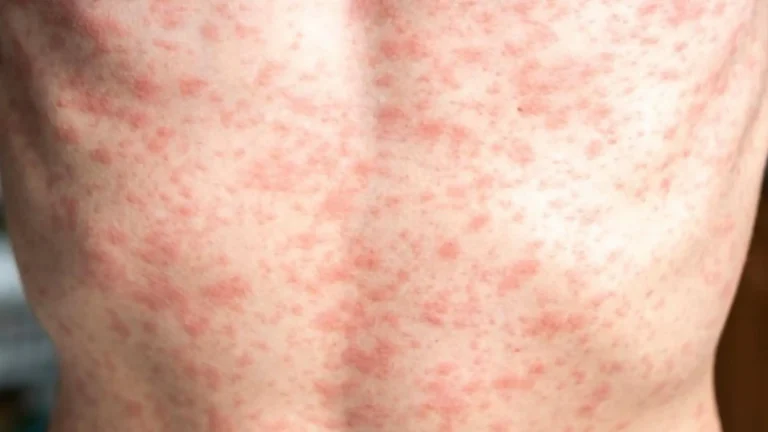 Entenda tudo sobre o sarampo e a importância de se vacinar